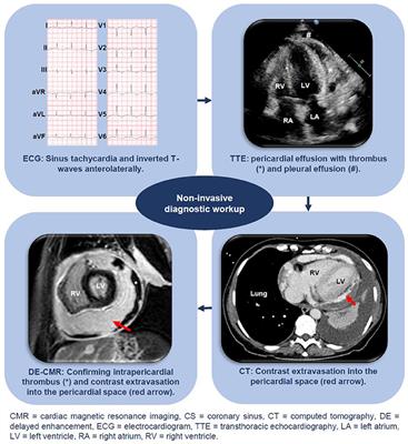 Case Report: An Unusual Cause for Recurrent Hemopericardium in a Patient With Dyspnea